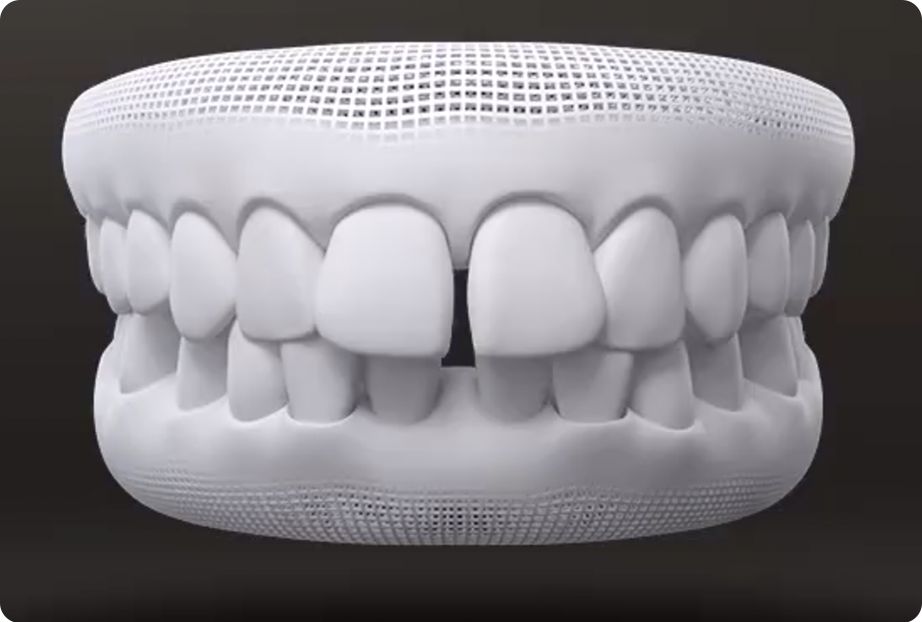 3D-Modell zeigt Zahnluecken