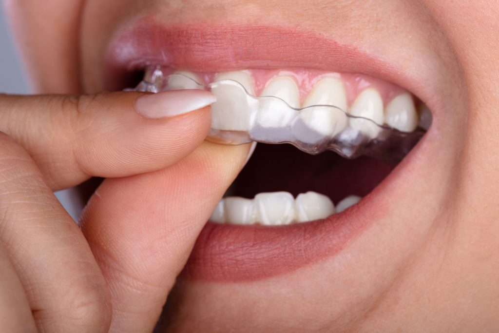 Nahaufnahme Frau die sich eine Zahnschiene aus dem Mund nimmt