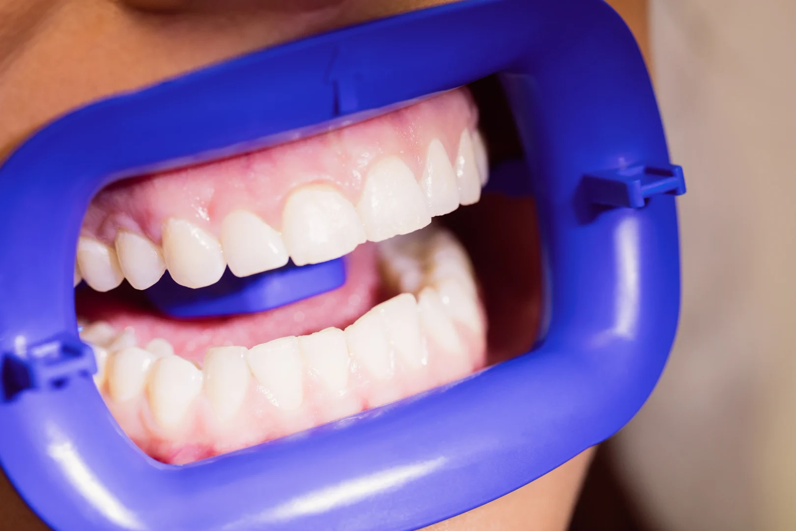 Zahnkorrektur mit Aligner trotz Zahnkrone oder Implantat – kieferorthopädische Behandlung für Erwachsene in Schäftlarn